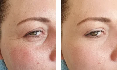 Rétinol pour le visage résultats avant:après