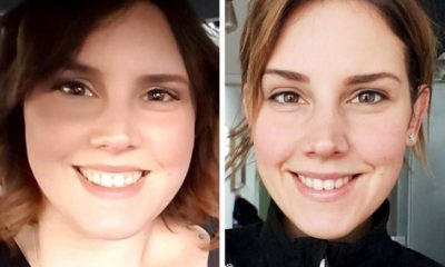 Perte de poids visage avant et après