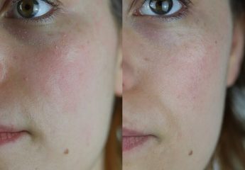 huile de noisette visage avant après