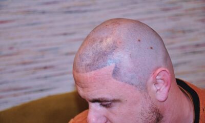 micropigmentation-cheveux-danger