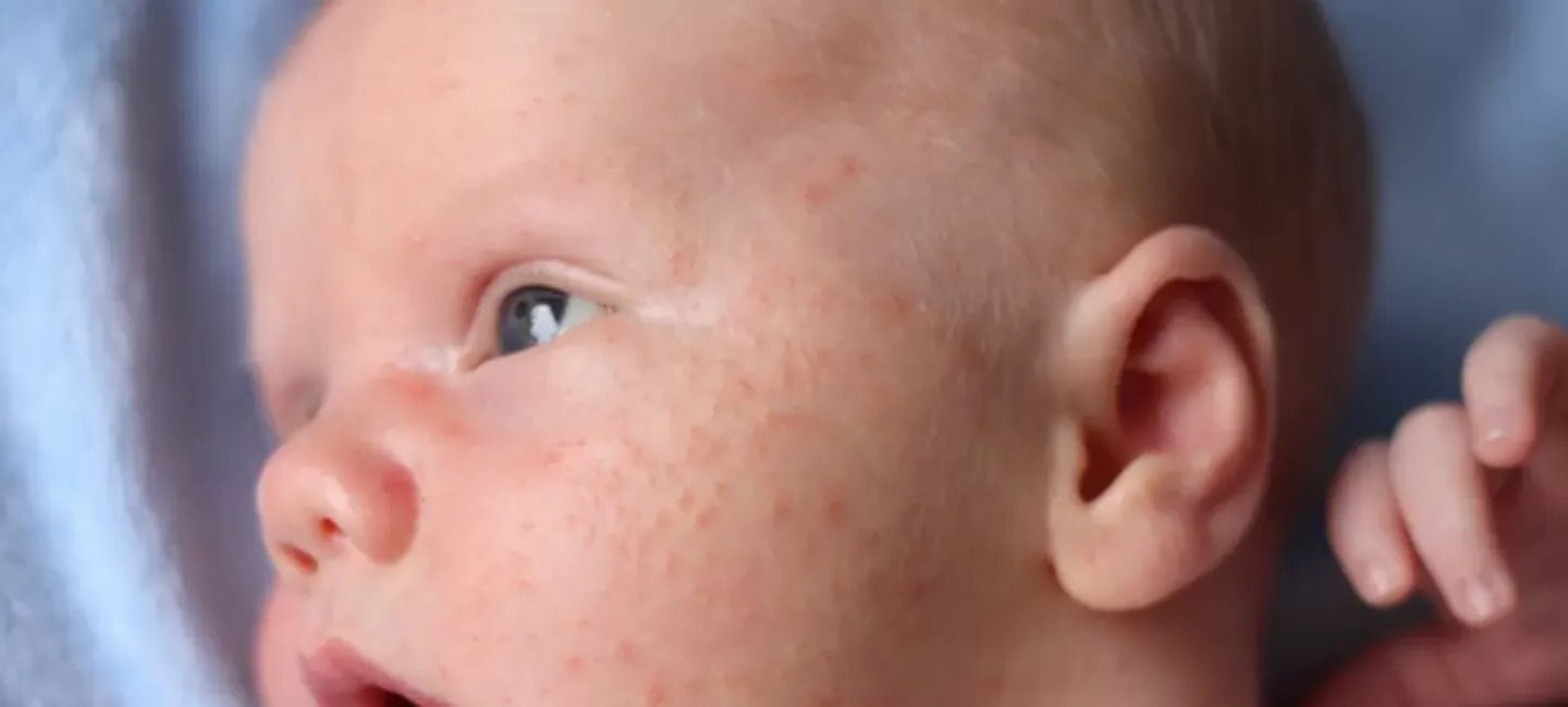 acne-du-nourrisson