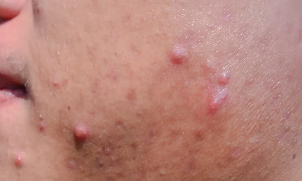 Micro kyste visage : identification et solutions de soin