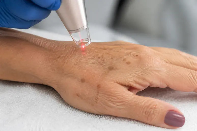 Traitement laser ciblant un lentigo tache brune sur le dos d'une main d'adulte.