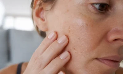 Lentigo et taches brunes : comment les reconnaître et que faire ?