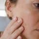 Lentigo et taches brunes : comment les reconnaître et que faire ?