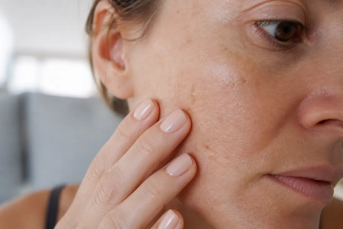 Lentigo et taches brunes : comment les reconnaître et que faire ?