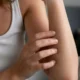 Petits points rouges sur la peau : de quoi s'agit-il vraiment ?