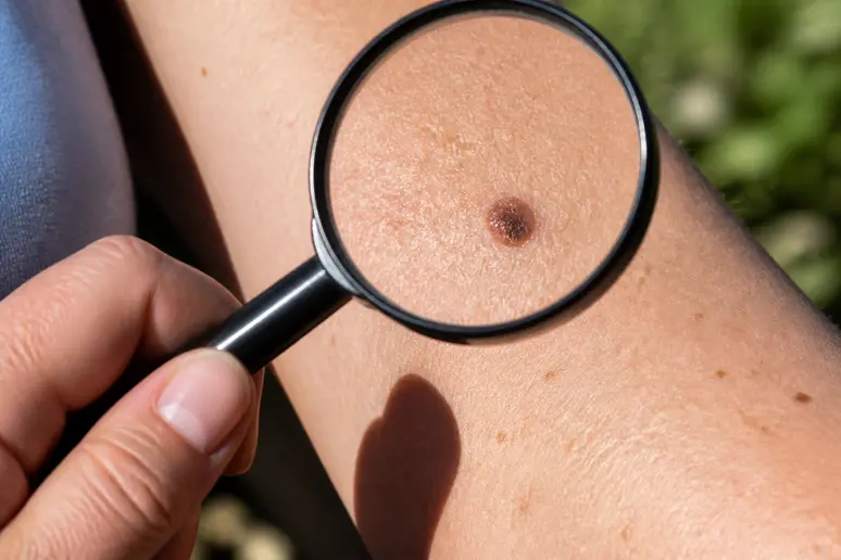 Auto-évaluation des taches rouges sur la peau pour identifier les signes d'un cancer.