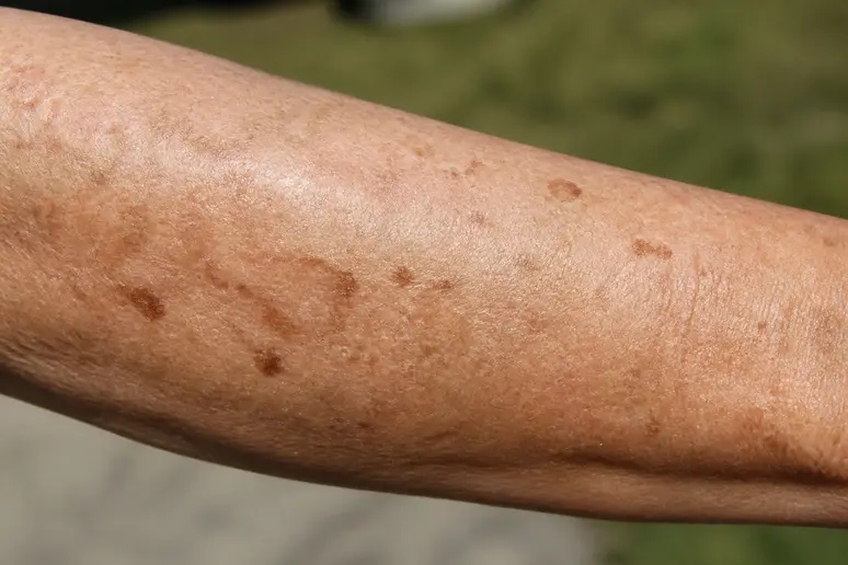 Observation rapprochée de taches cutanées liées aux effets cumulés du soleil sur la peau